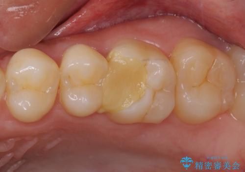 他院で神経を取ると言われた 神経を極力残した虫歯治療の症例 治療前