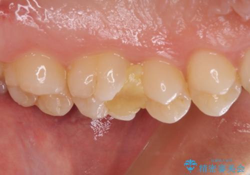 他院で神経を取ると言われた 神経を極力残した虫歯治療の治療前