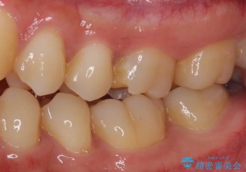 他院で神経を取ると言われた 神経を極力残した虫歯治療の治療前
