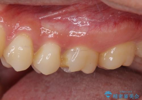 他院で神経を取ると言われた 神経を極力残した虫歯治療の治療前