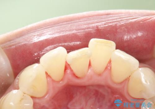 PMTCで舌ざわりをツルツルにの治療後