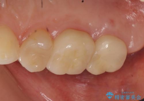 オールセラミッククラウン 虫歯治療・再根管治療の治療後