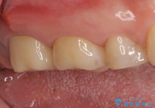 オールセラミッククラウン 虫歯治療・再根管治療の症例 治療後