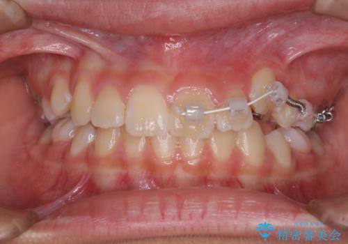 埋もれた犬歯を引っ張り出す 小学生のⅠ期治療の治療中