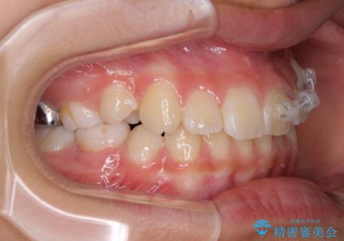 埋もれた犬歯を引っ張り出す　小学生のⅠ期治療の治療中