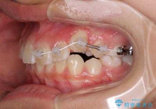 埋もれた犬歯を引っ張り出す 小学生のⅠ期治療の治療中