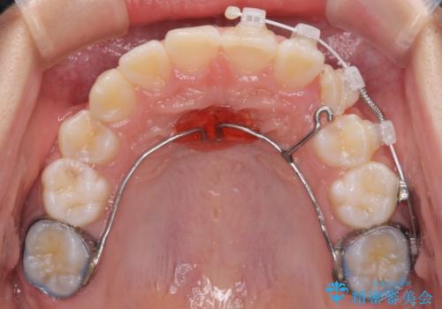 埋もれた犬歯を引っ張り出す 小学生のⅠ期治療の治療中