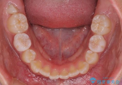 埋もれた犬歯を引っ張り出す 小学生のⅠ期治療の治療中