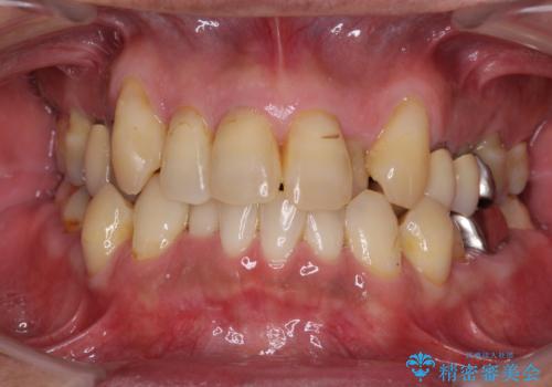 歯列不正と歯周病 総合歯科治療による全顎治療の症例 治療前
