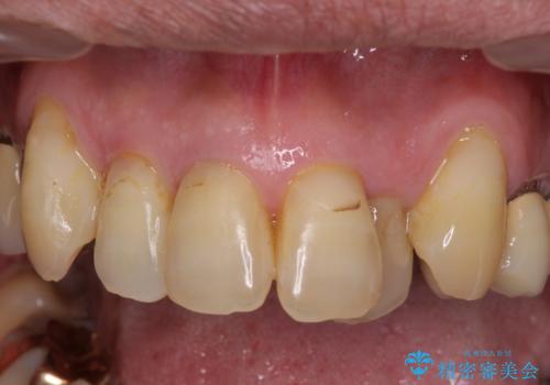 歯列不正と歯周病 総合歯科治療による全顎治療の治療前