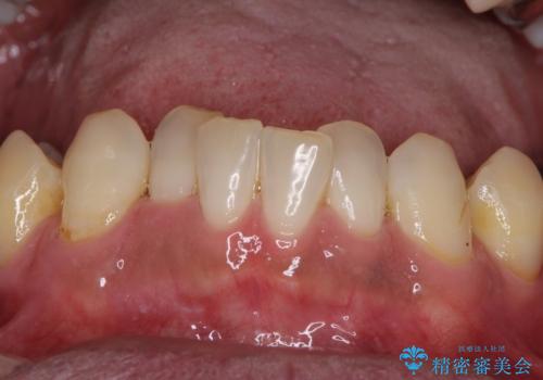 歯列不正と歯周病 総合歯科治療による全顎治療の治療前