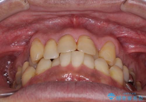 歯列不正と歯周病　総合歯科治療による全顎治療の治療前