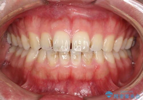 PMTCで前歯の着色・ステインを綺麗にの治療前