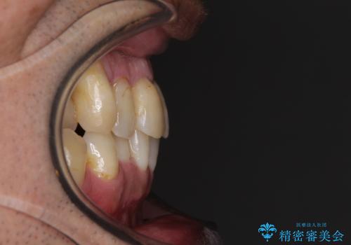 歯列不正と歯周病 総合歯科治療による全顎治療の治療前