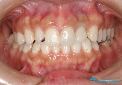 外れそうで不適合のかぶせ物の根管治療からの再治療の症例 治療後