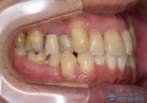 歯列不正と歯周病 総合歯科治療による全顎治療の治療前