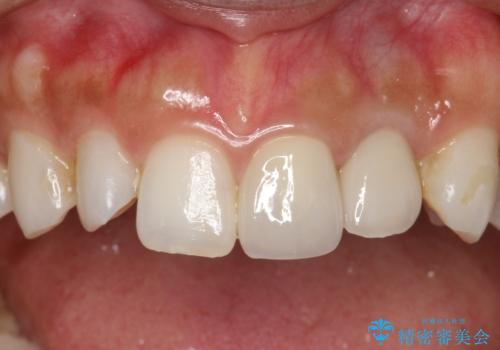 外れそうで不適合のかぶせ物の根管治療からの再治療の治療後