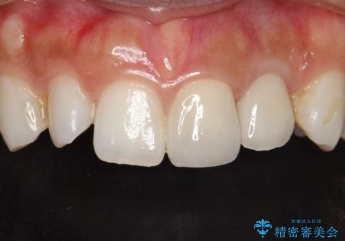 外れそうで不適合のかぶせ物の根管治療からの再治療の治療後