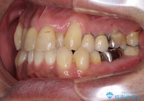 歯列不正と歯周病 総合歯科治療による全顎治療の治療前