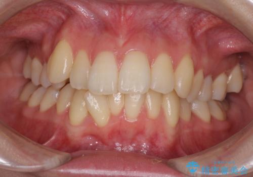 インビザラインでスッキリとした口元にの症例 治療前