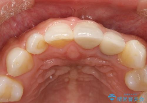 外れそうで不適合のかぶせ物の根管治療からの再治療の治療後