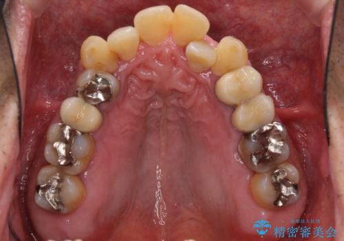 歯列不正と歯周病 総合歯科治療による全顎治療の治療前