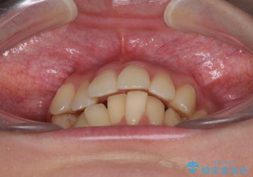 インビザラインでスッキリとした口元にの治療前