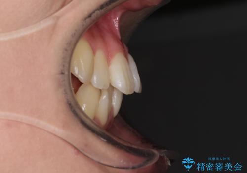 インビザラインでスッキリとした口元にの治療前