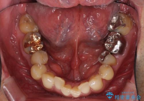 歯列不正と歯周病 総合歯科治療による全顎治療の治療前