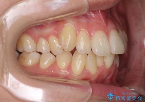 インビザラインでスッキリとした口元にの治療前