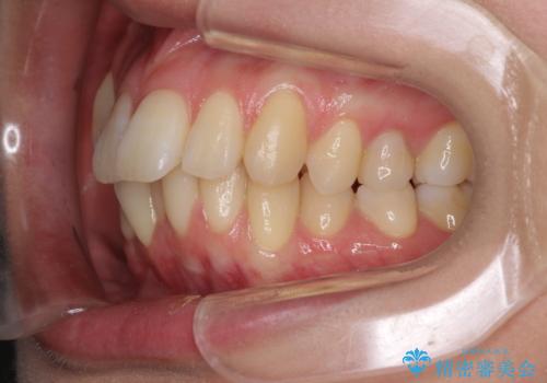 インビザラインでスッキリとした口元にの治療前