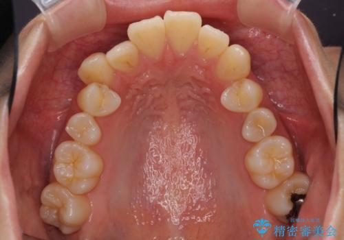 インビザラインでスッキリとした口元にの治療前