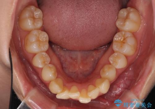 インビザラインでスッキリとした口元にの治療前