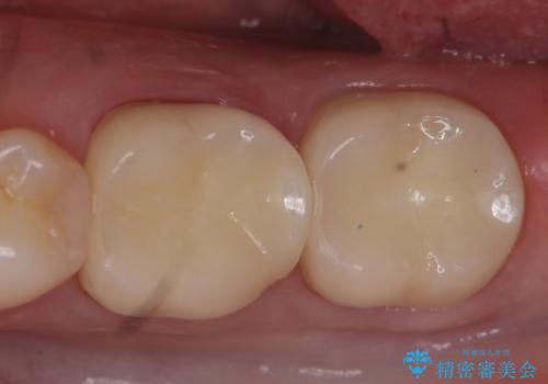 オールセラミッククラウン 咬むと痛む奥歯の治療の治療後