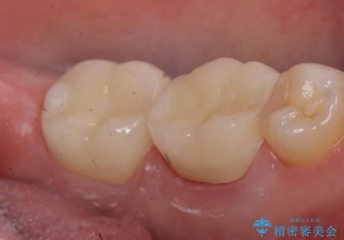 オールセラミッククラウン 咬むと痛む奥歯の治療の治療後
