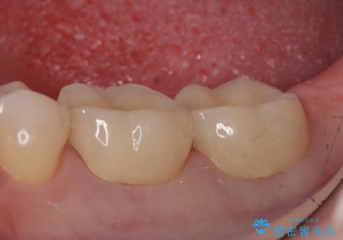 オールセラミッククラウン 咬むと痛む奥歯の治療の症例 治療後