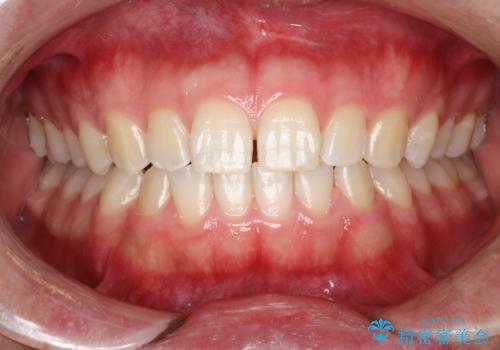 PMTCで前歯の着色・ステインを綺麗にの治療後