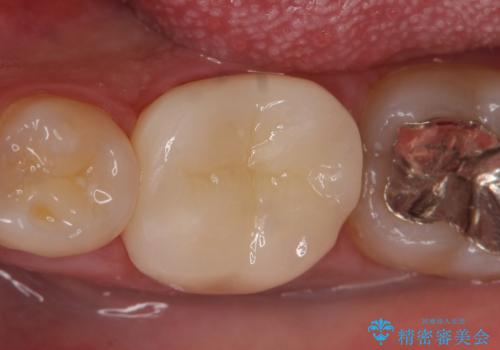 オールセラミッククラウン 知覚過敏の治療の治療後