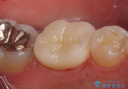 オールセラミッククラウン 知覚過敏の治療の治療後
