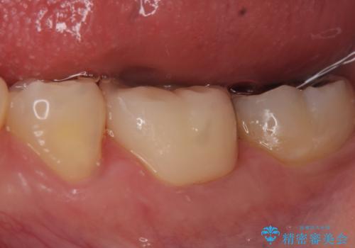 オールセラミッククラウン 知覚過敏の治療の症例 治療後