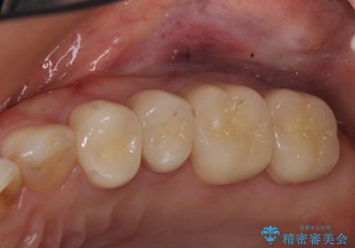 オールセラミッククラウン 銀歯を白くの治療後