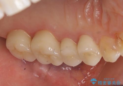 オールセラミッククラウン 銀歯を白くの治療後