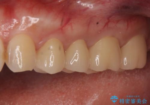 オールセラミッククラウン 銀歯を白く