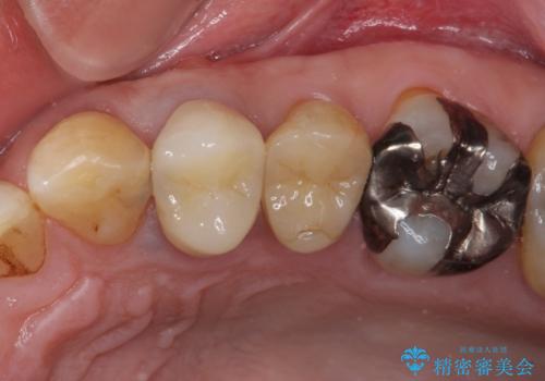 割れてしまった小臼歯 インプラントによる補綴治療の治療前