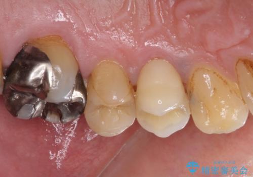 割れてしまった小臼歯 インプラントによる補綴治療の治療前