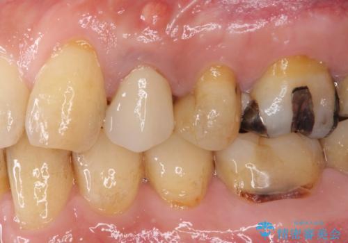 割れてしまった小臼歯 インプラントによる補綴治療の治療前