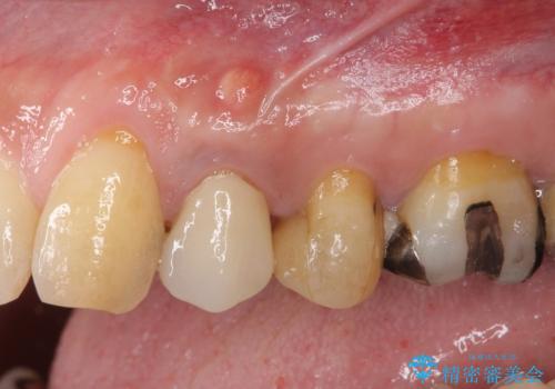 割れてしまった小臼歯 インプラントによる補綴治療の治療前