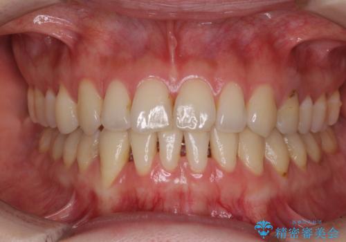 下顎前歯の歯肉退縮　歯肉移植による根面被覆の治療前
