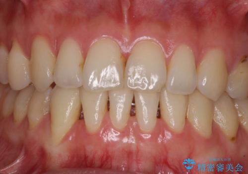 下顎前歯の歯肉退縮 歯肉移植による根面被覆の治療前