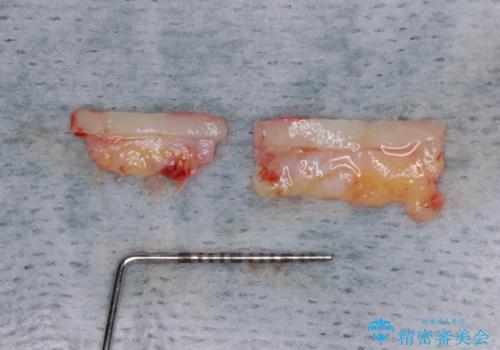 下顎前歯の歯肉退縮　歯肉移植による根面被覆の治療中